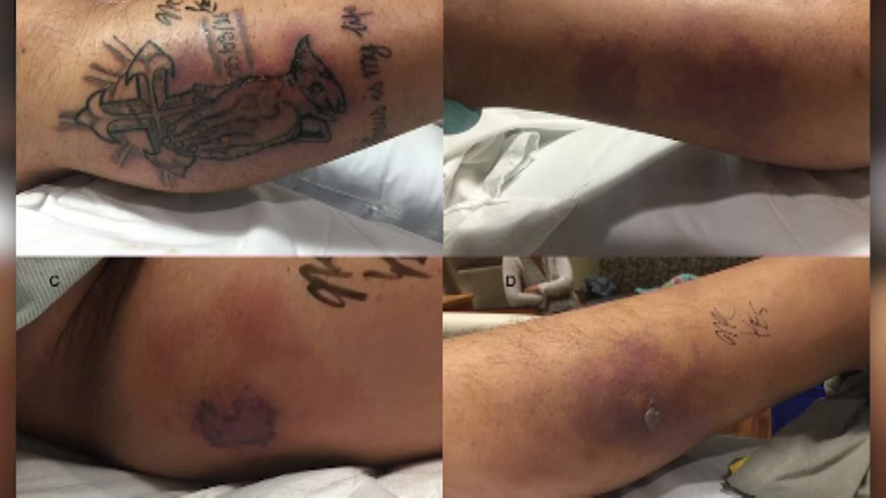 Man dies from infection after swimming with tattoo